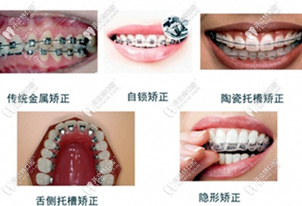 牙齒矯正器的類型