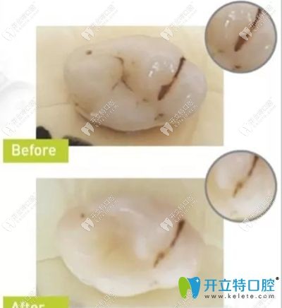 射频牙刷使用前后的牙齿清洁效果图