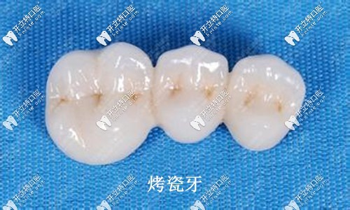 烤瓷牙外觀