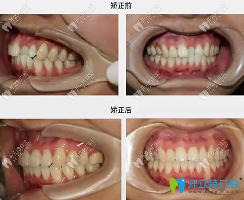 牙齒矯正前后對比圖