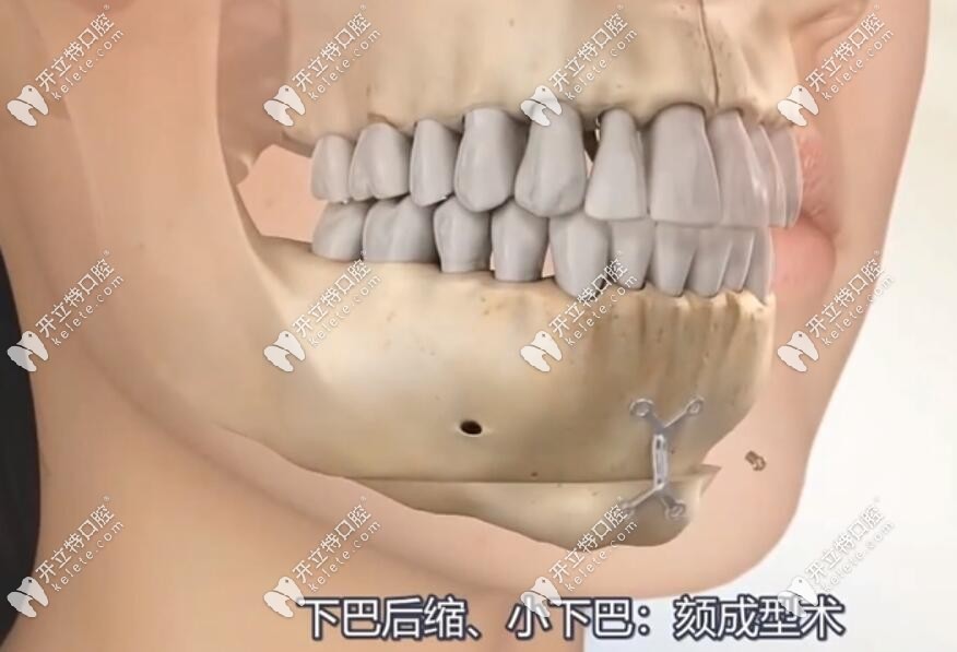 頦成型手術(shù)模擬