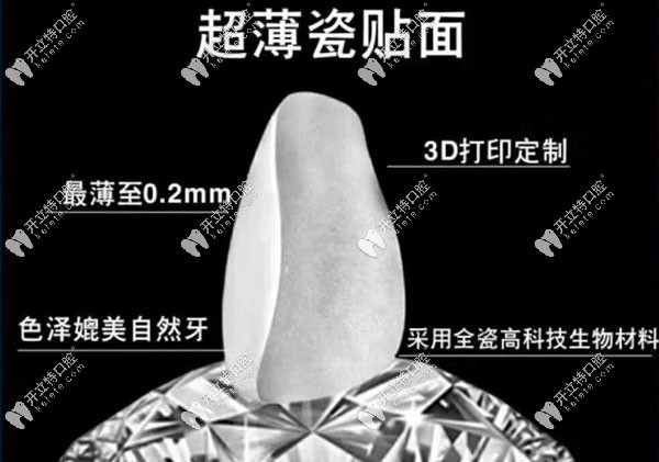 超薄瓷贴面细节展示