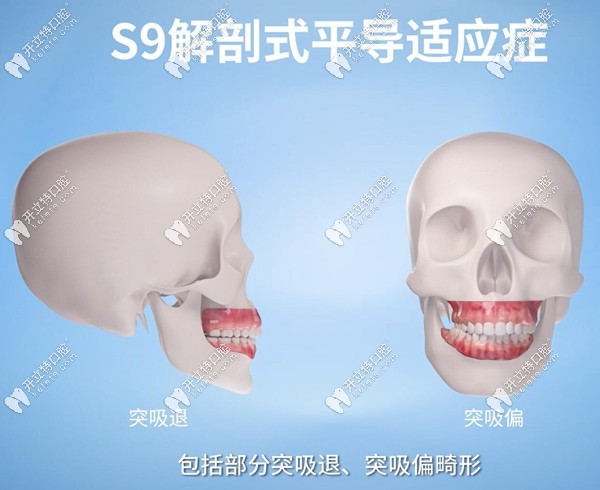 正雅s9隱形矯正器的適應(yīng)癥
