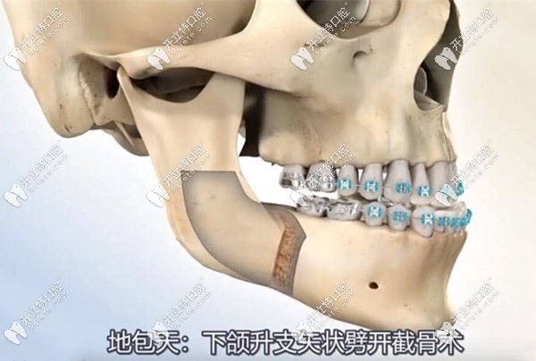 下頜升支矢狀劈開截骨術(shù)