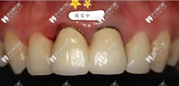 這口烤瓷牙害我一生