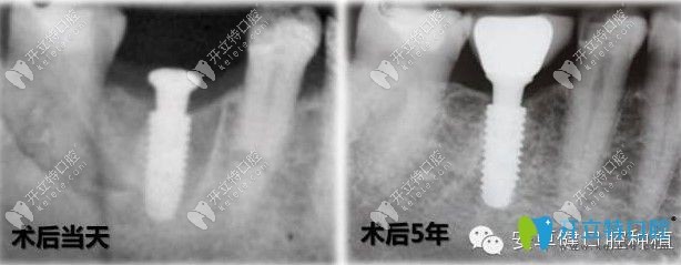 安卓健种植体植入5年后与牙槽骨的融合情况