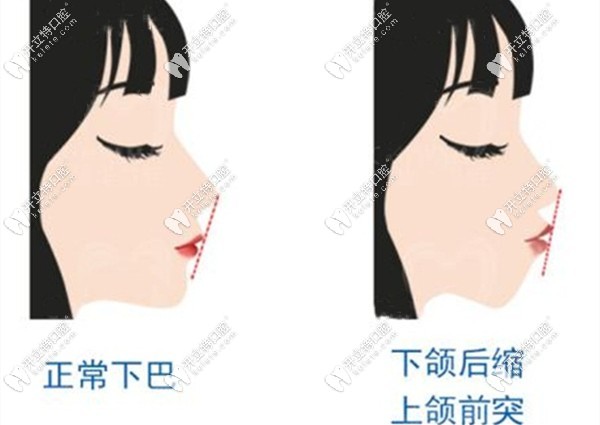 凸嘴和正常面型矯正前后對比