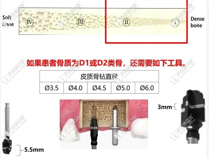 皮质骨钻的使用