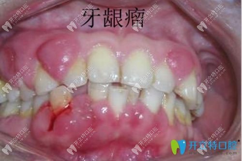 妊娠期牙齦瘤的癥狀圖
