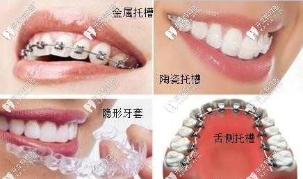 舌側(cè)矯正效果好還是唇側(cè)牙套效果好