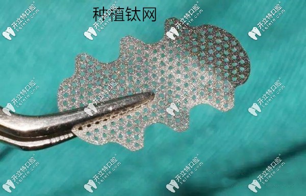 牙科鈦網(wǎng)示意圖