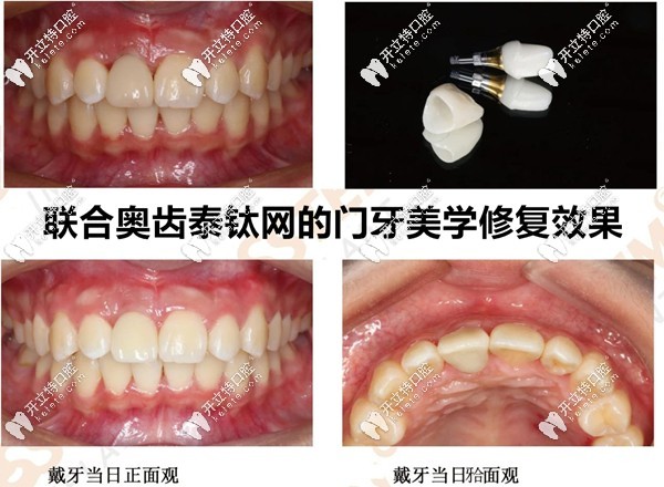 奧齒泰鈦網(wǎng)的美學(xué)修復(fù)效果圖