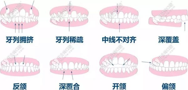 兰州矫正牙齿