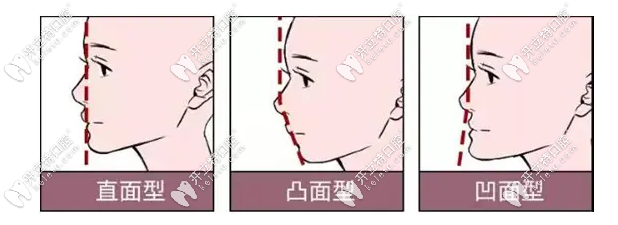 凹面性面部示意圖