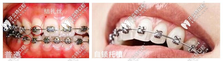 金属矫正和自锁托槽矫正的区别