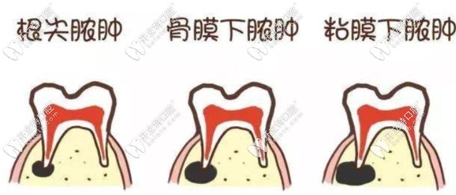 炎癥性牙痛的癥狀表現(xiàn)