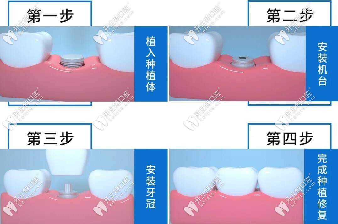 種植牙的修復(fù)步驟及原理