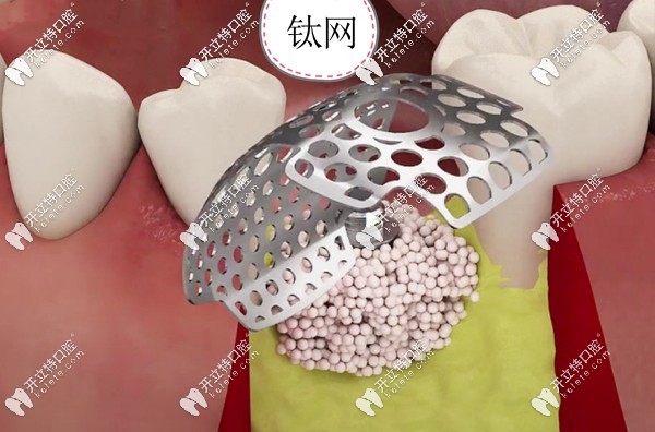 種植鈦網(wǎng)的型號和厚度