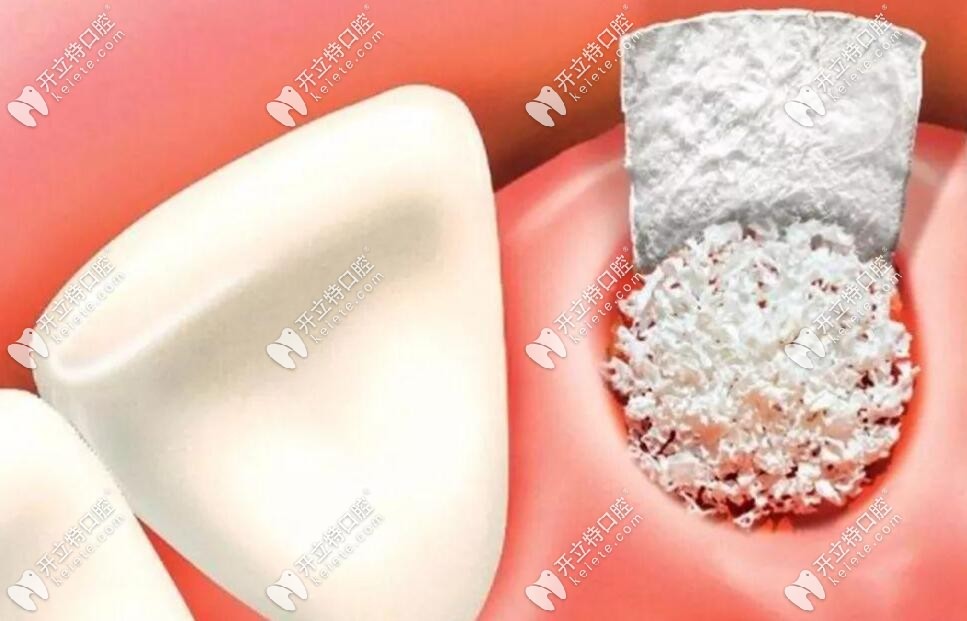 骨粉骨膜動畫圖