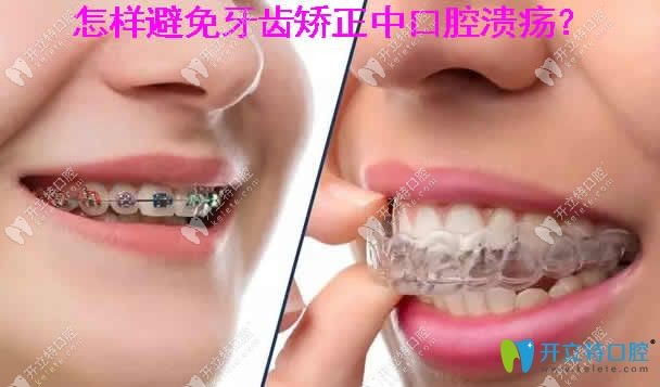 怎样避免牙齿矫正中口腔溃疡