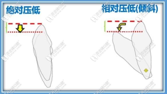 隱適美矯正深覆合壓低前牙