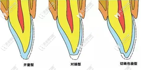 牙齒貼面預(yù)備的三種類型包括哪些