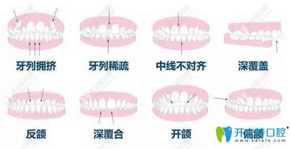 兒童牙齒矯正年齡