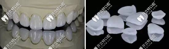 瓷貼面外觀