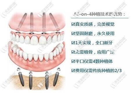 60岁以上老人做种植牙怎么样