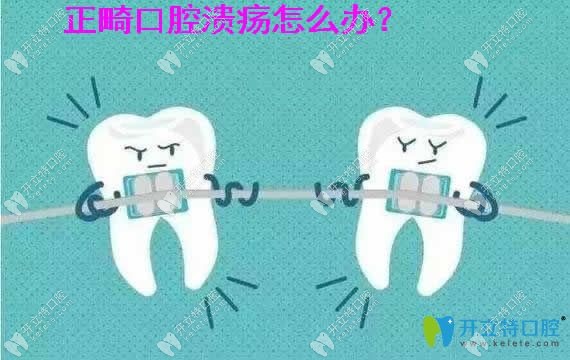 正畸口腔溃疡怎么办