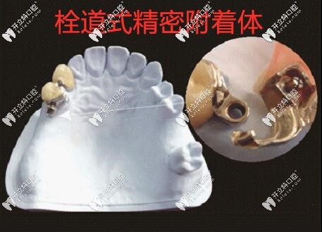 栓道式精密附著體