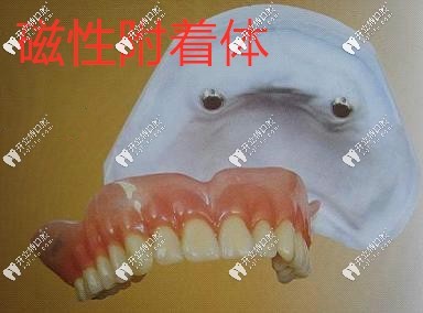 磁性附著體