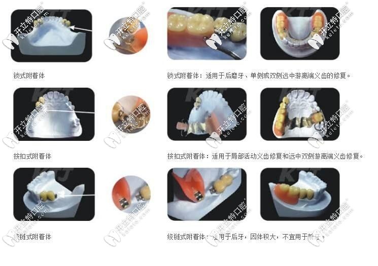 附著體義齒的適應(yīng)證