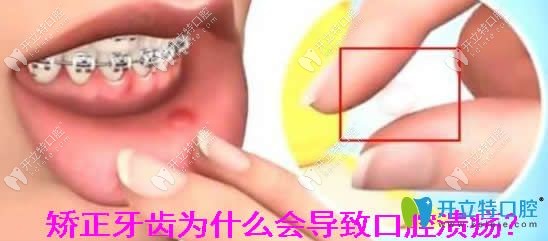 牙齿矫正为什么会引起口腔溃疡
