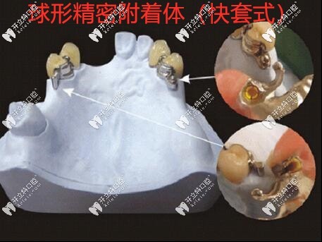 球形精密附著體（快套式）
