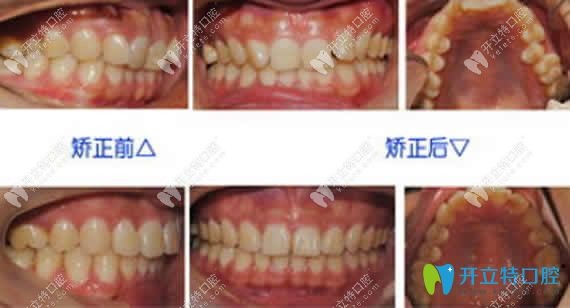 兒童牙齒矯正前后效果對(duì)比圖