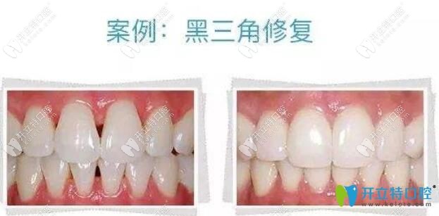 牙齒貼面修復黑三角案例
