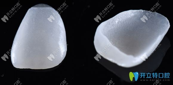 那么牙齒做瓷貼面后期會變黃嗎