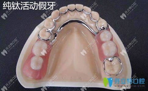純鈦活動假牙的價格