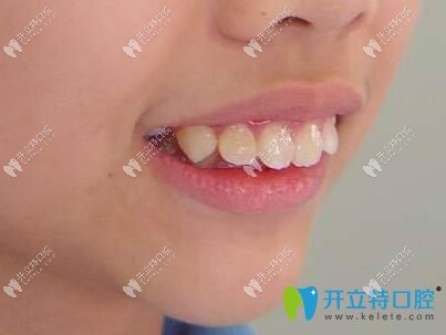 小孩子牙槽骨突出