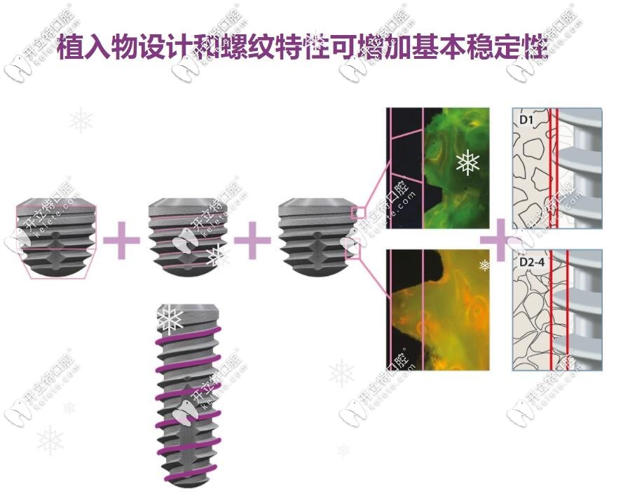 sky种植体的特殊螺纹设计