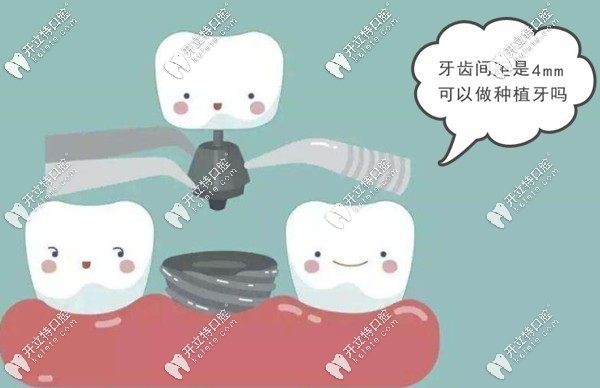 缺牙的牙間距是4mm可以做種植牙嗎