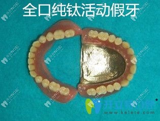 全口純鈦活動假牙的優(yōu)勢點