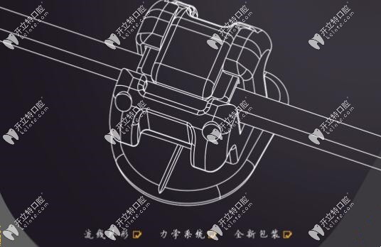 埃蒙迪金属自锁托槽