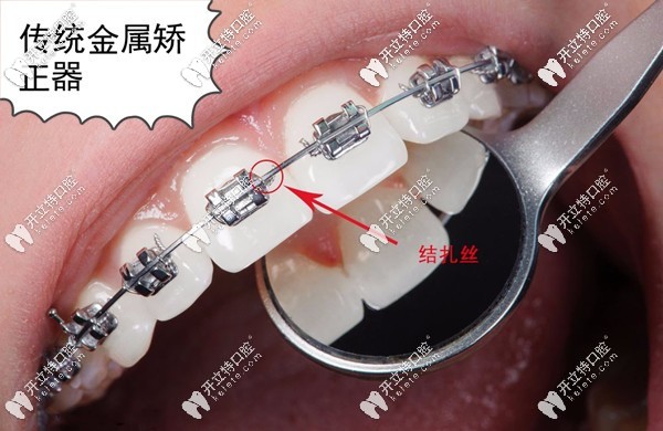 傳統(tǒng)金屬矯正器