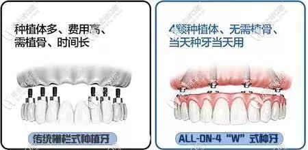 all-on-4全口種植牙對比傳統(tǒng)種植牙的優(yōu)點(diǎn)