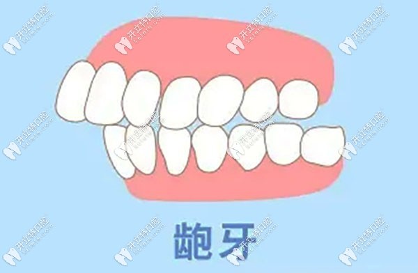 齙牙戴了3年拼多多牙套沒變化
