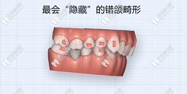 闭锁性深覆合的危害