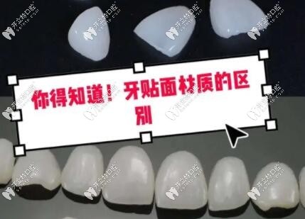 牙齒樹脂貼面和瓷貼面哪個好kelete.com