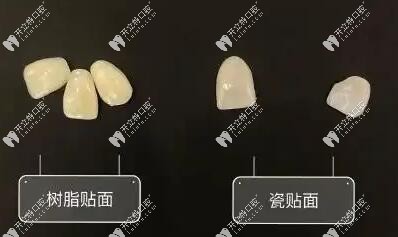 牙齒樹脂貼面和瓷貼面哪個好kelete.com